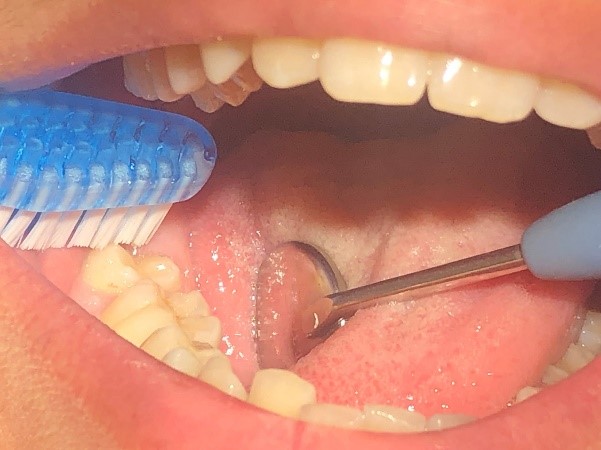 På det andet billede ses bageste tand blive børstet med en tandbørste, på tværs af tanden i frembrudsfasen.
