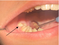 På det første billede ses bageste tand delvist dækket af tandkød, vist med en sort pil.