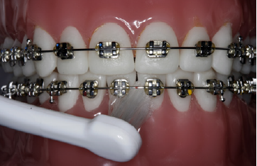 på billedet ses tænder med fast bøjle som bliver børstet med en solo tandbørste