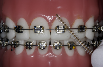 på billedet ses tænder med fast bøjle som bliver renset med en mellemrumsbørste