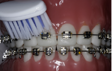 på billedet ses tænder med fast bøjle som bliver børstet med en tandbørste