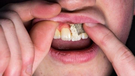 billedet viser en mund hvorpå snus placeres