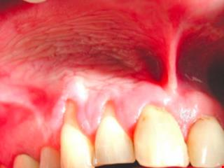 billedet viser tandhalse blottet 