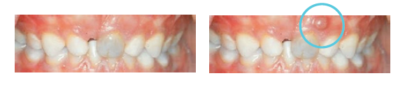 På det første billede er en tand som har været slået og er blevet mørk. På det andet billede er der kommet en tandbyld ved en tand, som er slået. Dette er tegn på infektion. Det er vigtigt, at I henvender jer til tandklinikken.