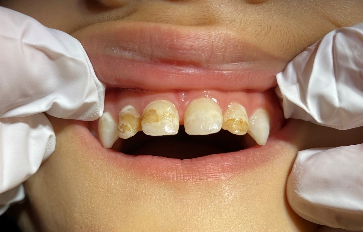 På billedet ses fortænder og hjørnetænder i overmunden på et barn på tre år. Der ses huller i fortænderne forårsaget af natamning og manglende tandbørstning.