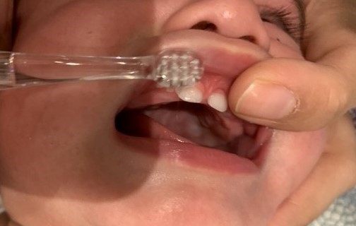  På billedet ses en babys mund med to fortænder i overmunden. Overlæben holdes oppe med en pegefinger i den ene side, mens en tandbørste børster fra den anden side.