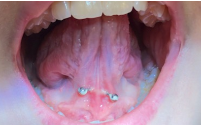   Piercing under tunge. Bakterieansamling i form af plak/tandsten ses på piercingen.