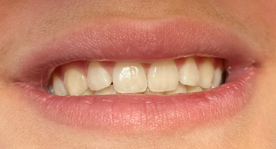  Det første billede viser en mund med sunde intakte tænder
