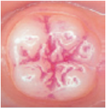 Billedet viser en kindtand med plak i de dybe furer. Plakken er farvet rødt, så den kan ses tydeligt i tandens furer.