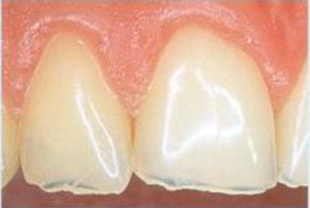 Det andet billede viser tænder med syreskader. Tænderne er matte og der ses en sort streg tæt på fortænderne skærekant. Dette skyldes at tænderne er ætset tynde på grund af syreskader og derfor er tandemaljen mere gennemskinlig. 